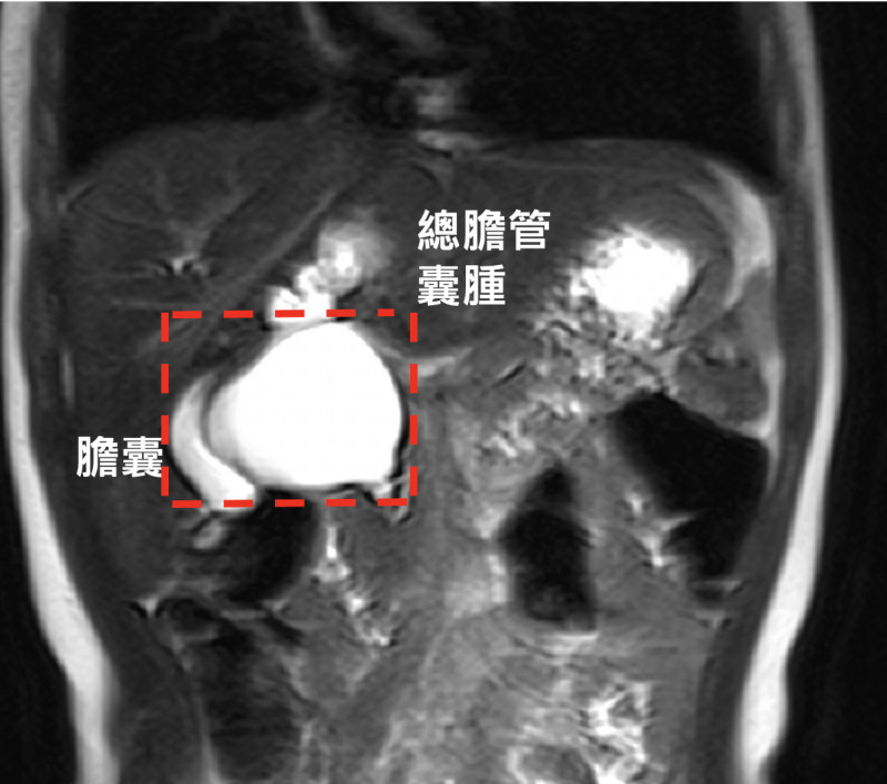 盧小妹罹患總膽管囊腫,米粒大小的總膽管已腫脹如乒乓球。(記者蔡淑媛翻攝) 盧小妹罹患總膽管囊腫,米粒大小的總膽管已腫脹如乒乓球。(記者蔡淑媛翻攝)