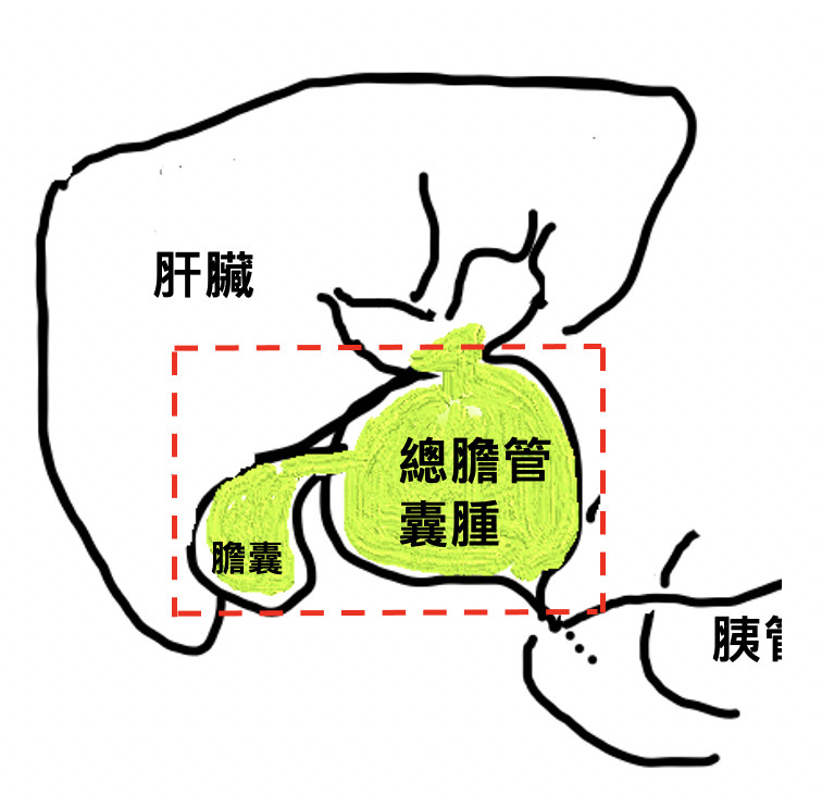 盧小妹總膽管囊腫,米粒大小的總膽管已腫脹如乒乓球。(記者蔡淑媛翻攝) 盧小妹總膽管囊腫,米粒大小的總膽管已腫脹如乒乓球。(記者蔡淑媛翻攝)