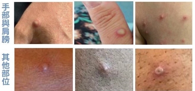 M痘感染症狀有皮膚出疹、水泡、斑疹、斑丘疹、膿疱等。(衛生局提供) M痘感染症狀有皮膚出疹、水泡、斑疹、斑丘疹、膿疱等。(衛生局提供)