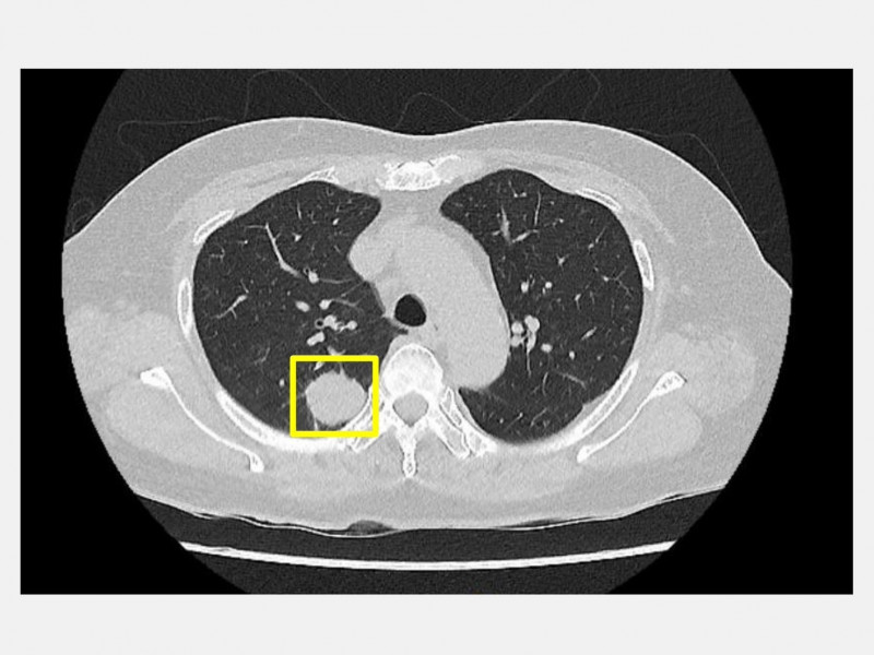 手術前胸部電腦斷層,右側肺臟腫瘤(方框處)。(大里仁愛醫院提供) 手術前胸部電腦斷層,右側肺臟腫瘤(方框處)。(大里仁愛醫院提供)