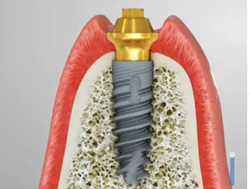 健康網》植牙貴桑桑 牙醫：選擇終生保固更有保障