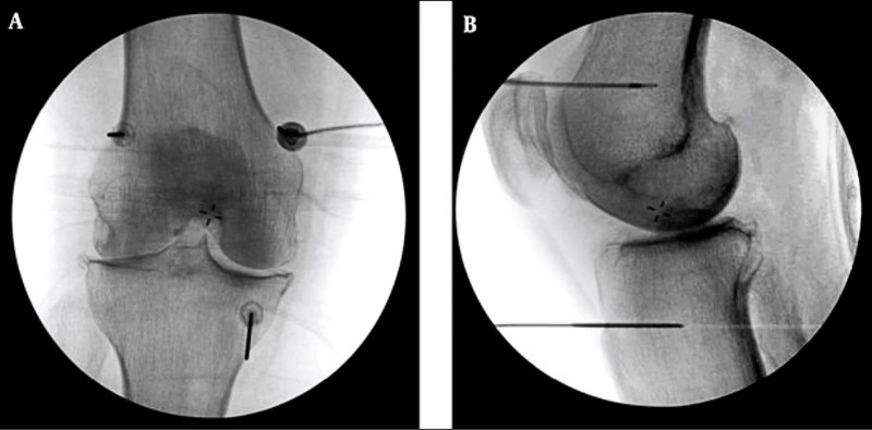 ▲高頻熱凝療法以X光定位,將電極導針導引至膝蓋的主要感覺神經叢,藉熱能與電效應,麻痺痛覺神經。(台北慈濟醫院提供) ▲高頻熱凝療法以X光定位,將電極導針導引至膝蓋的主要感覺神經叢,藉熱能與電效應,麻痺痛覺神經。(台北慈濟醫院提供)