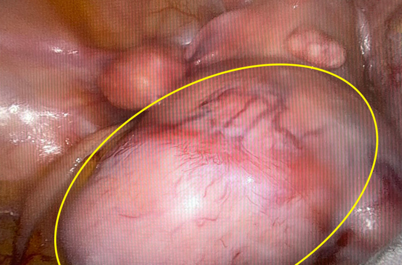 粉領族罹患子宮肌瘤,子宮長滿肌瘤,最大顆有拳頭大。(記者蔡淑媛翻攝) 粉領族罹患子宮肌瘤,子宮長滿肌瘤,最大顆有拳頭大。(記者蔡淑媛翻攝)