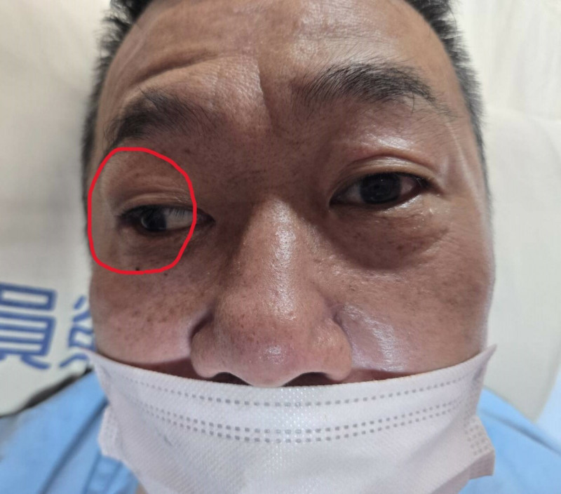 黃男左眼可正常轉動,但右眼眼球(紅圈處)卻偏向一邊,經檢查確認是左側腦幹中風。(員榮醫療體系提供) 黃男左眼可正常轉動,但右眼眼球(紅圈處)卻偏向一邊,經檢查確認是左側腦幹中風。(員榮醫療體系提供)