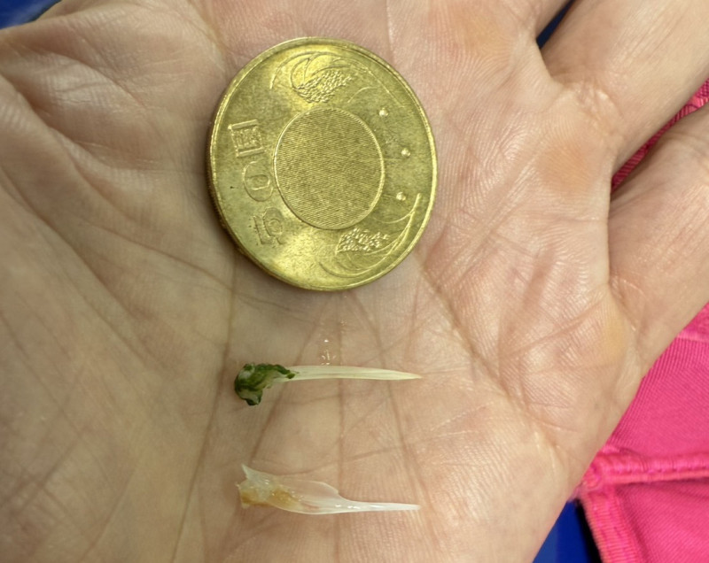 張先生現食道卡了兩根銅板大的魚刺。(記者蔡淑媛攝) 張先生現食道卡了兩根銅板大的魚刺。(記者蔡淑媛攝)