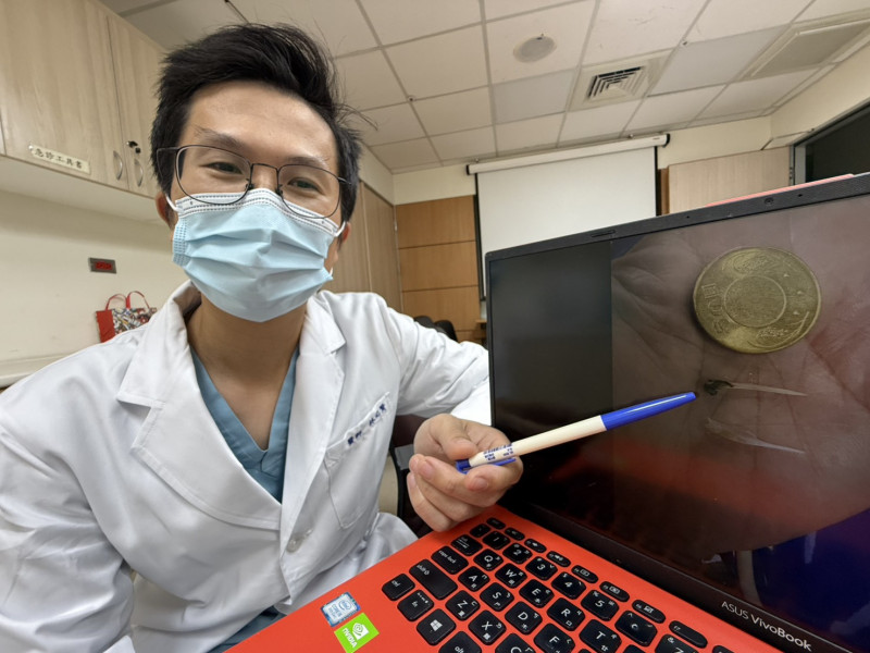 林記賢醫師指張先生夾出2根3公分長的魚刺。(記者蔡淑媛攝) 林記賢醫師指張先生夾出2根3公分長的魚刺。(記者蔡淑媛攝)