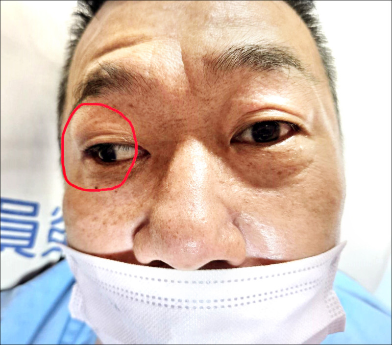 ▲黃男左眼可正常轉動,但右眼眼球(紅圈處)卻偏向一邊,經檢查確認是左側腦幹中風。(員榮醫療體系提供) ▲黃男左眼可正常轉動,但右眼眼球(紅圈處)卻偏向一邊,經檢查確認是左側腦幹中風。(員榮醫療體系提供)