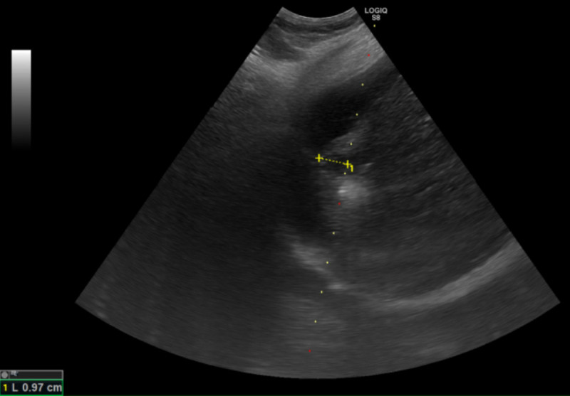 圖為超音波導引下的電燒治療,黃色標記處為肝臟腫瘤,周圍白色處為氣化範圍。(台北慈濟醫院提供) 圖為超音波導引下的電燒治療,黃色標記處為肝臟腫瘤,周圍白色處為氣化範圍。(台北慈濟醫院提供)