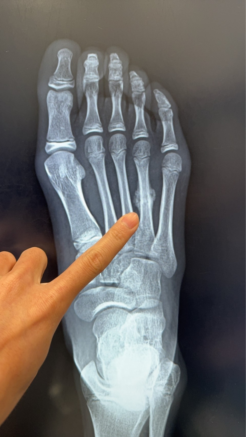 1名11歲女童右腳掌出現「蹠骨應力性骨折」情形,且已出現癒合跡象。(骨科醫師陳建宏提供) 1名11歲女童右腳掌出現「蹠骨應力性骨折」情形,且已出現癒合跡象。(骨科醫師陳建宏提供)