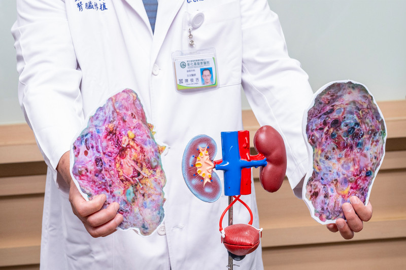 陳女因多囊腎導致腎臟異常腫大,切除後雙側病腎合計重達6公斤為正常人的20倍。(彰基提供) 陳女因多囊腎導致腎臟異常腫大,切除後雙側病腎合計重達6公斤為正常人的20倍。(彰基提供)