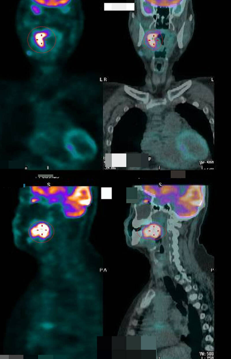 程女正子攝影顯示咽喉癌(紅圈處)(彰化醫院提供) 程女正子攝影顯示咽喉癌(紅圈處)(彰化醫院提供)