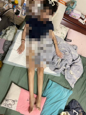 一名BMI僅24的年輕女患者做SASI減重手術後因維他命B缺乏發生腦病變,術後近6個月仍法正常飲食,體重僅剩37公斤。(家屬提供) 一名BMI僅24的年輕女患者做SASI減重手術後因維他命B缺乏發生腦病變,術後近6個月仍法正常飲食,體重僅剩37公斤。(家屬提供)