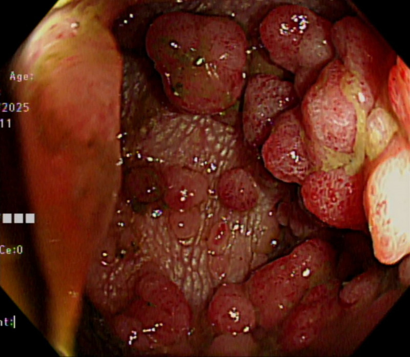 家族性腺瘤性瘜肉症患者腸道布滿上百或上千顆瘜肉。(嘉基提供 ) 家族性腺瘤性瘜肉症患者腸道布滿上百或上千顆瘜肉。(嘉基提供 )