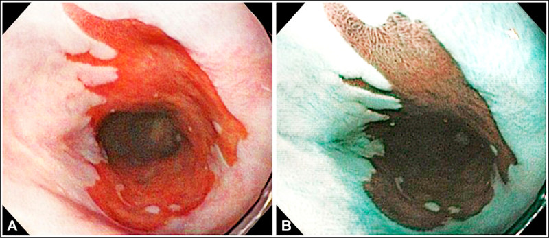 ▲有顏色的部分是巴瑞特食道的病灶。(照片提供/傅重睿) ▲有顏色的部分是巴瑞特食道的病灶。(照片提供/傅重睿)