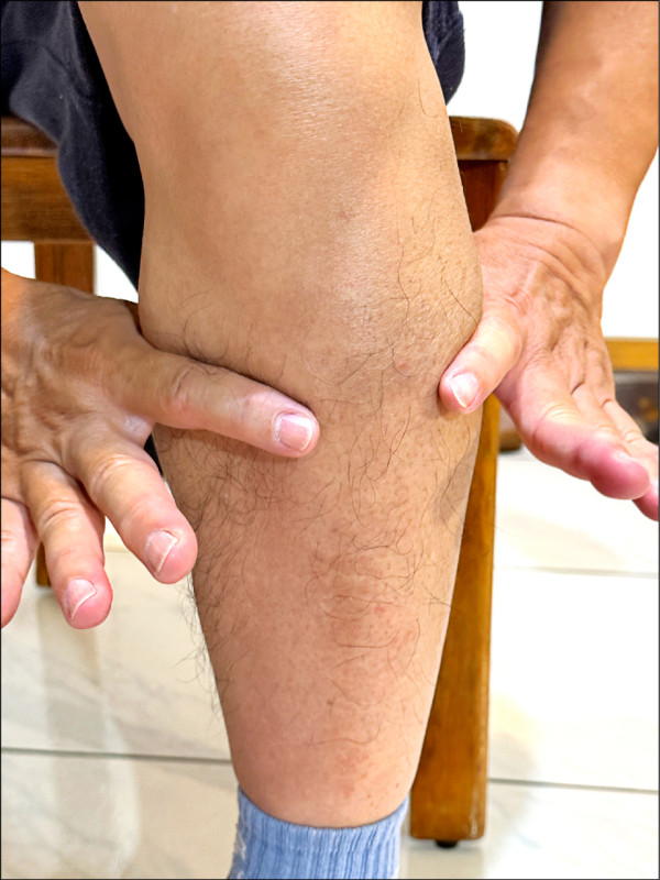 ▲如何檢測肌少症?自己雙手的食指與拇指,在小腿最粗的地方圈起來,有縫隙就可能是「肌少症」。(北護大高齡健康照護系助理教授王曉萍提供) ▲如何檢測肌少症?自己雙手的食指與拇指,在小腿最粗的地方圈起來,有縫隙就可能是「肌少症」。(北護大高齡健康照護系助理教授王曉萍提供)