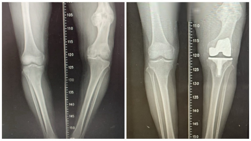黃姓老翁術後長短腿獲大幅改善(左為術前,右為術後)。(豐原醫院提供) 黃姓老翁術後長短腿獲大幅改善(左為術前,右為術後)。(豐原醫院提供)