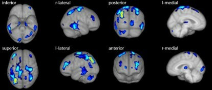 Alzheimer’s Diagnosis: Yadong Hospital AI Imaging Partnership