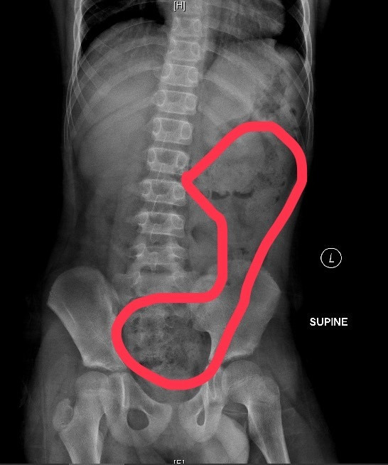 11歲玩手機男孩因腹痛、嘴唇發紫被送急診,診斷為便秘,圖上紅圈範圍為積糞區。(阮綜合醫院提供) 11歲玩手機男孩因腹痛、嘴唇發紫被送急診,診斷為便秘,圖上紅圈範圍為積糞區。(阮綜合醫院提供)