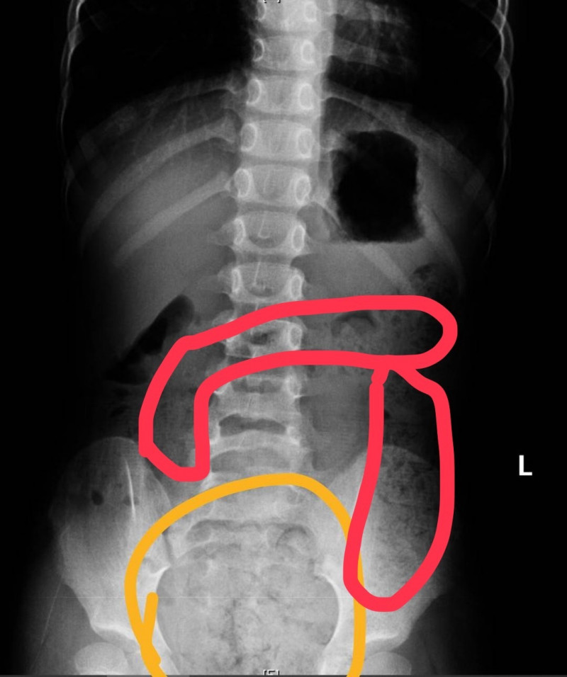 6歲剛上學的憋便女童因腹痛被送急診,診斷為便秘,圖上紅、黃線範圍為積糞區。(阮綜合醫院提供) 6歲剛上學的憋便女童因腹痛被送急診,診斷為便秘,圖上紅、黃線範圍為積糞區。(阮綜合醫院提供)