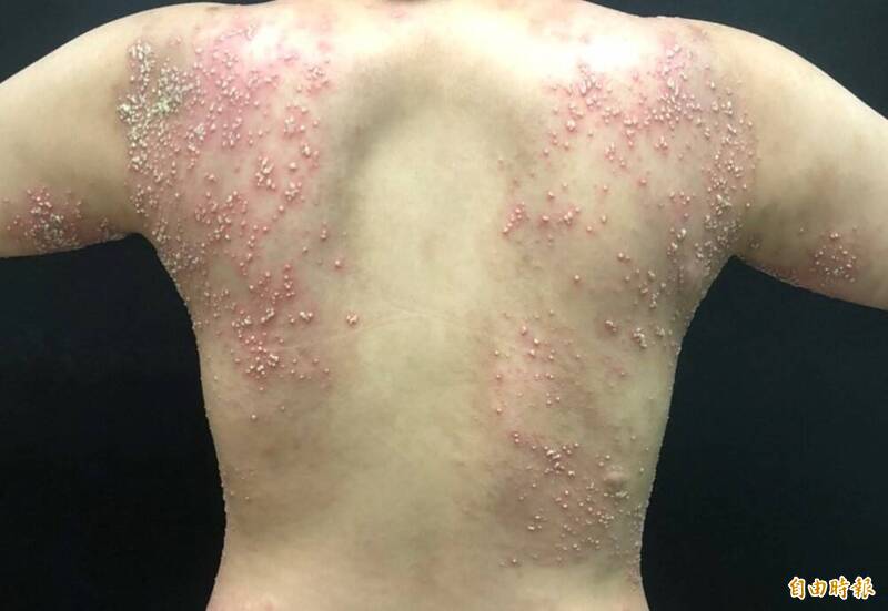 頭皮、手腳出現明顯的紅斑與白屑。林口長庚皮膚科主治醫師黃毓惠指出,病友可能因搔癢抓頭皮導致傷口,增加感染風險。圖為示意圖,非當事人。(資料照) 頭皮、手腳出現明顯的紅斑與白屑。林口長庚皮膚科主治醫師黃毓惠指出,病友可能因搔癢抓頭皮導致傷口,增加感染風險。圖為示意圖,非當事人。(資料照)