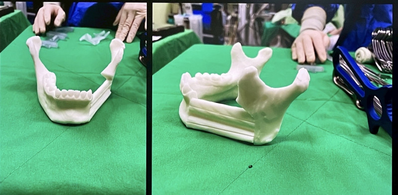 手術前用咬合模擬的3D列印成品,製作顎骨立體模型,模擬腫瘤切除與重建角度。(彰化秀傳紀念醫院提供) 手術前用咬合模擬的3D列印成品,製作顎骨立體模型,模擬腫瘤切除與重建角度。(彰化秀傳紀念醫院提供)