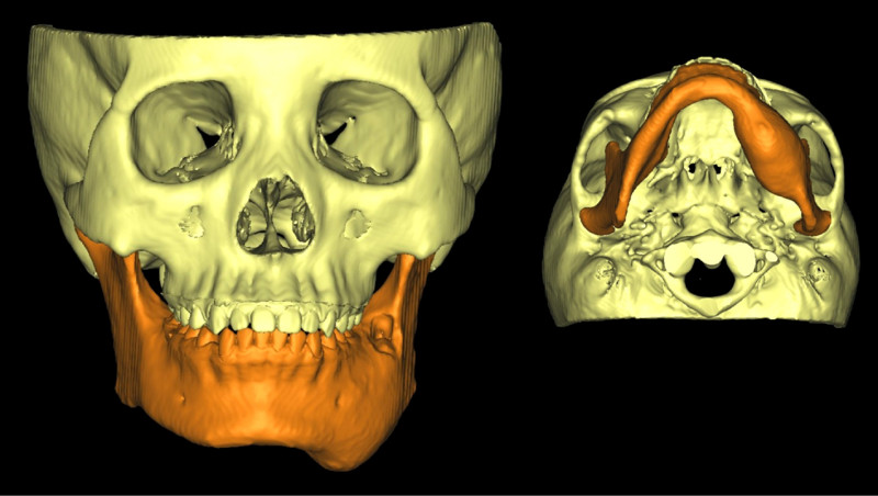 ▲3D電腦斷層顯示,患者的左下顎腫脹,進一步診斷為下顎骨良性腫瘤作怪。(彰化秀傳醫院提供) ▲3D電腦斷層顯示,患者的左下顎腫脹,進一步診斷為下顎骨良性腫瘤作怪。(彰化秀傳醫院提供)