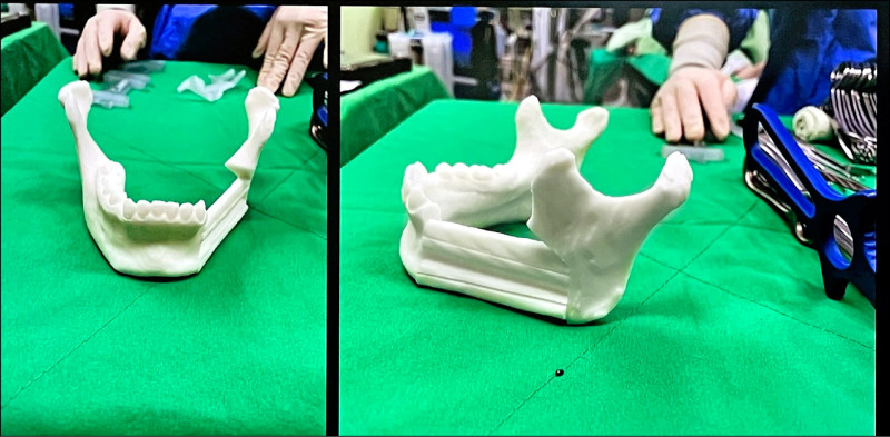 ▲手術前用咬合模擬的3D列印成品,製作顎骨立體模型,模擬腫瘤切除與重建角度。(彰化秀傳醫院提供) ▲手術前用咬合模擬的3D列印成品,製作顎骨立體模型,模擬腫瘤切除與重建角度。(彰化秀傳醫院提供)