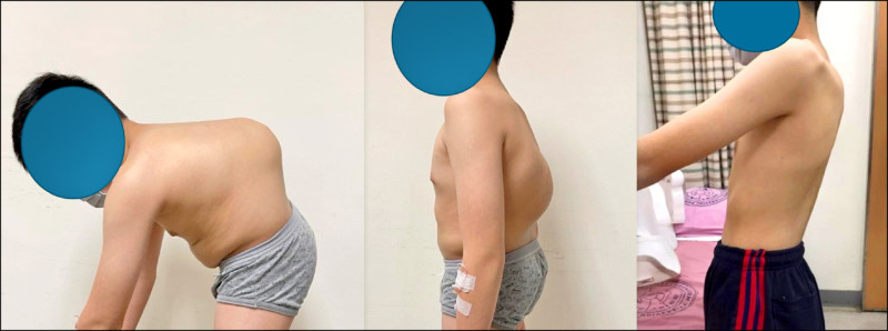 ▲1名12歲男童因脊椎先天嚴重畸形,接受脊椎矯正手術後,脊椎恢復直立。(記者王俊忠翻攝) ▲1名12歲男童因脊椎先天嚴重畸形,接受脊椎矯正手術後,脊椎恢復直立。(記者王俊忠翻攝)