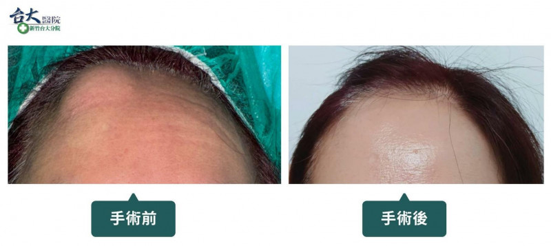 額部骨瘤手術前(左)與手術後(右)的外觀比較。新竹臺大分院整形外科張晏誠醫師以微創內視鏡切除腫瘤,術後額頭平整,切口隱藏於髮際線內。(新竹臺大分院提供) 額部骨瘤手術前(左)與手術後(右)的外觀比較。新竹臺大分院整形外科張晏誠醫師以微創內視鏡切除腫瘤,術後額頭平整,切口隱藏於髮際線內。(新竹臺大分院提供)