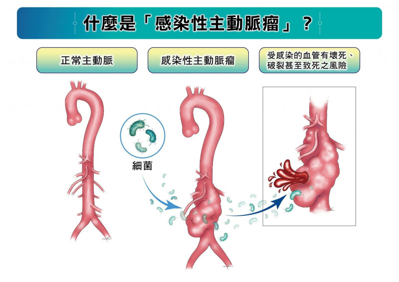 感染性主動脈瘤是由病原體(如細菌)入侵主動脈,導致血管壁壞死、破裂的罕見疾病,若未即時治療,死亡風險極高。(長庚醫院提供) 感染性主動脈瘤是由病原體(如細菌)入侵主動脈,導致血管壁壞死、破裂的罕見疾病,若未即時治療,死亡風險極高。(長庚醫院提供)