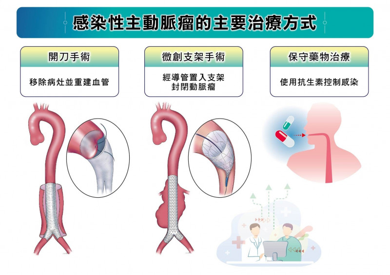 感染性主動脈瘤的三種主要治療方式,開刀手術、血管內微創修補以及保守藥物治療,不同方法各有適用情況,醫師會依病人的整體健康狀況與疾病特性,選擇最合適的治療方案。(長庚醫院提供) 感染性主動脈瘤的三種主要治療方式,開刀手術、血管內微創修補以及保守藥物治療,不同方法各有適用情況,醫師會依病人的整體健康狀況與疾病特性,選擇最合適的治療方案。(長庚醫院提供)