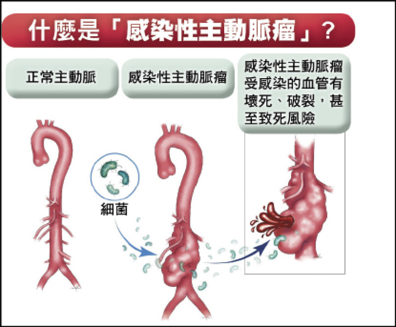 ▲感染性主動脈瘤是由病原體(如細菌)入侵主動脈,導致血管壁壞死、破裂的罕見疾病,若未即時治療,死亡風險極高。(長庚醫院提供) ▲感染性主動脈瘤是由病原體(如細菌)入侵主動脈,導致血管壁壞死、破裂的罕見疾病,若未即時治療,死亡風險極高。(長庚醫院提供)