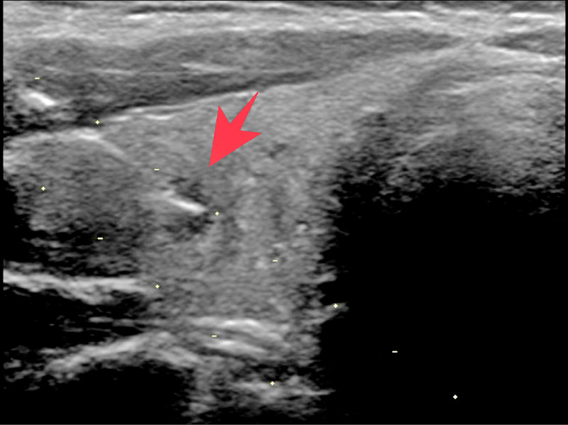 ▲圖2:超音波導引下進行細針穿刺檢查,證實是甲狀腺乳突癌。(照片提供/新陳代謝科主治醫師王子源) ▲圖2:超音波導引下進行細針穿刺檢查,證實是甲狀腺乳突癌。(照片提供/新陳代謝科主治醫師王子源)