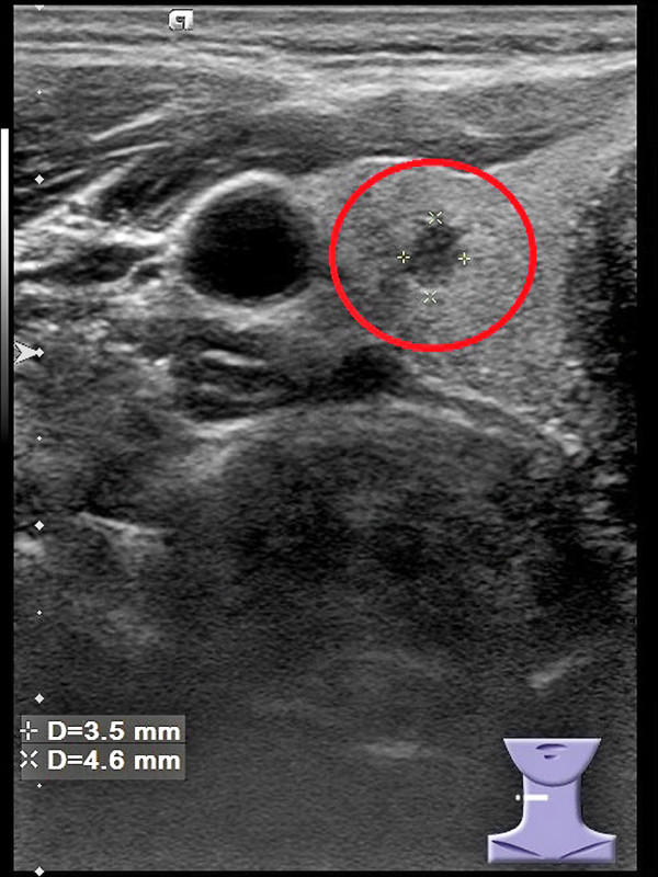 ▲圖1:影像顯示陳先生的右側甲狀腺有一個小結節。(照片提供/新陳代謝科主治醫師王子源) ▲圖1:影像顯示陳先生的右側甲狀腺有一個小結節。(照片提供/新陳代謝科主治醫師王子源)
