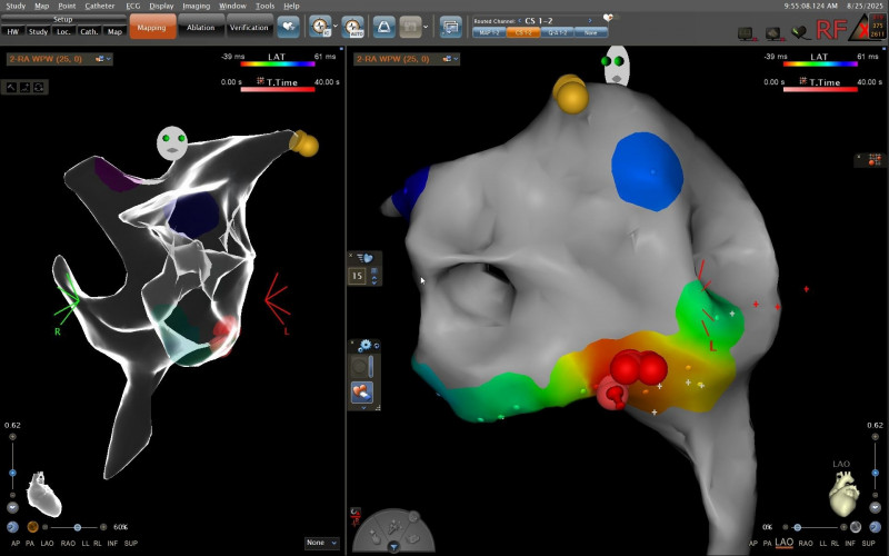 透過3D電生理定位系統,醫師能在立體模型中清楚辨識正常傳導路徑(黃點處)與副傳導路徑跟燒灼位置(紅點處),並以電氣燒灼術精準處理異常傳導點,恢復心律正常。(安南醫院提供) 透過3D電生理定位系統,醫師能在立體模型中清楚辨識正常傳導路徑(黃點處)與副傳導路徑跟燒灼位置(紅點處),並以電氣燒灼術精準處理異常傳導點,恢復心律正常。(安南醫院提供)