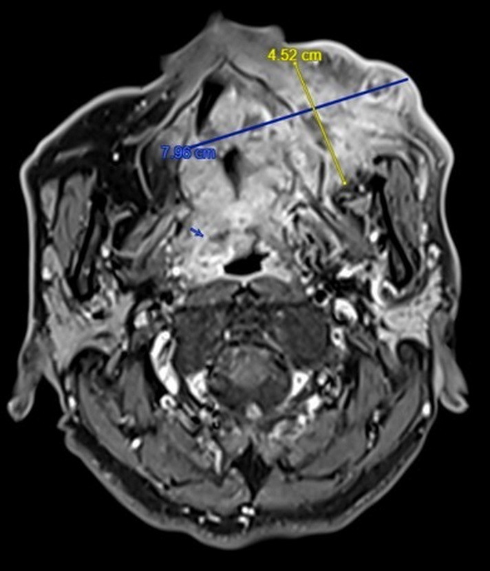 手術前的核磁共振顯示腫瘤已經侵犯口腔、鼻竇以及顏面皮膚,整個手術長達10幾個小時,手術以後還要接受半年的化療和電療,治療相對棘手。(彰基提供) 手術前的核磁共振顯示腫瘤已經侵犯口腔、鼻竇以及顏面皮膚,整個手術長達10幾個小時,手術以後還要接受半年的化療和電療,治療相對棘手。(彰基提供)