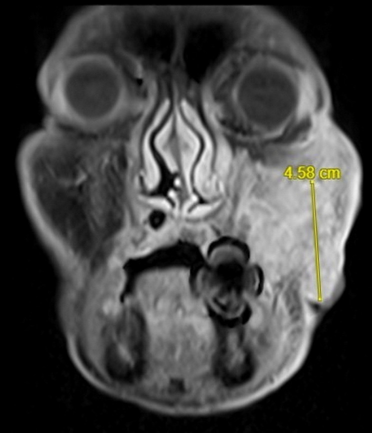 從核磁共振顯示,腫瘤已經侵犯口腔、鼻竇及顏面皮膚,範圍大。(彰基提供) 從核磁共振顯示,腫瘤已經侵犯口腔、鼻竇及顏面皮膚,範圍大。(彰基提供)