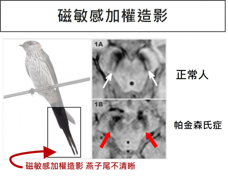 腦部磁振造影顯示,正常人會出現清晰的燕子尾;帕金森氏症患者的燕子尾較為模糊。(郭綜合醫院提供) 腦部磁振造影顯示,正常人會出現清晰的燕子尾;帕金森氏症患者的燕子尾較為模糊。(郭綜合醫院提供)
