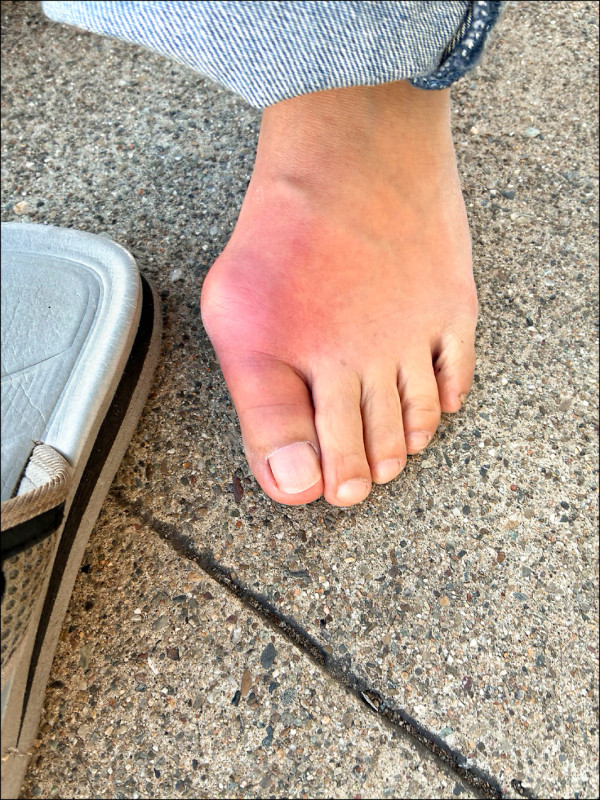 ▲患者因痛風,左腳趾痛腫幾乎無法走路。(照片提供/謝明蓁) ▲患者因痛風,左腳趾痛腫幾乎無法走路。(照片提供/謝明蓁)