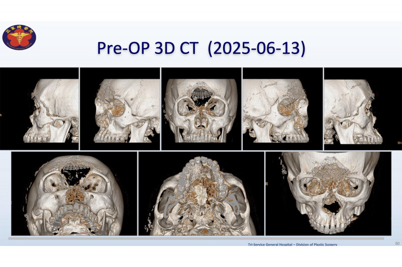 一名25歲男子因T91步槍槍傷,鼻骨、額骨全數消失,面部粉碎並導致腦部外露,經三軍總醫院跨科治療與重建,如今外觀與功能皆恢復良好,重新回到社會生活。(三總提供) 一名25歲男子因T91步槍槍傷,鼻骨、額骨全數消失,面部粉碎並導致腦部外露,經三軍總醫院跨科治療與重建,如今外觀與功能皆恢復良好,重新回到社會生活。(三總提供)