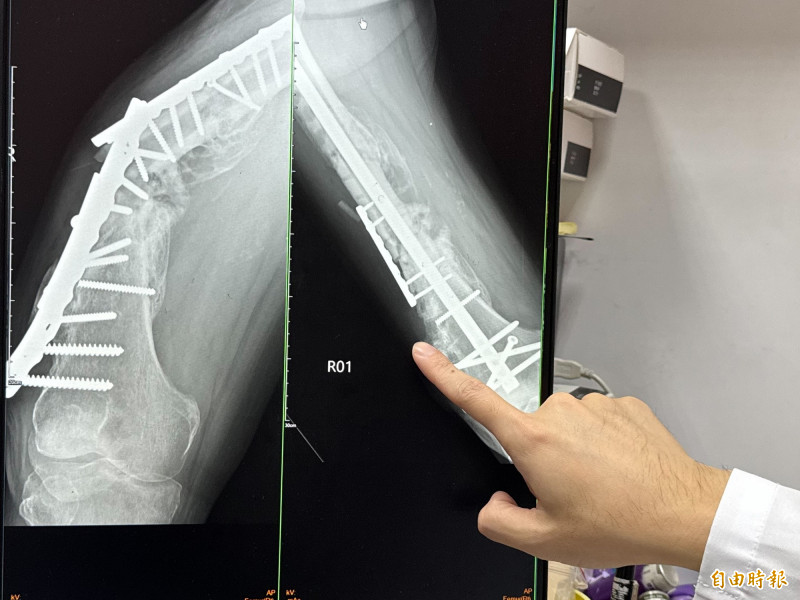 8旬翁大腿斷三截因鋼板金屬疲勞斷裂(左),再用髓內鋼釘(右)固定。(記者張軒哲攝) 8旬翁大腿斷三截因鋼板金屬疲勞斷裂(左),再用髓內鋼釘(右)固定。(記者張軒哲攝)
