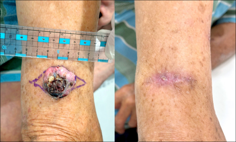 ▲病人的右手臂有1顆3公分大的腫瘤(左圖),經門診手術完整切除(右圖)。(照片提供/江紀萱) ▲病人的右手臂有1顆3公分大的腫瘤(左圖),經門診手術完整切除(右圖)。(照片提供/江紀萱)