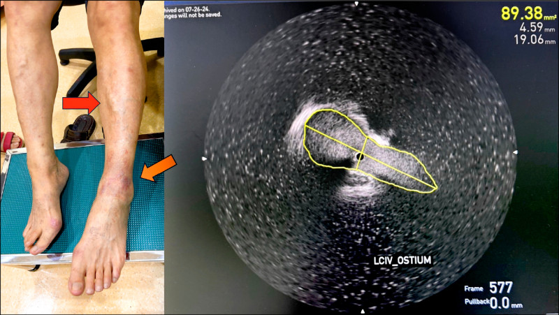 小腿反覆乾癢 小心靜脈出問題
