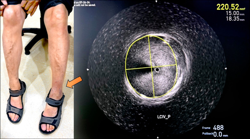 小腿反覆乾癢 小心靜脈出問題
