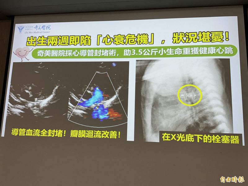 出生2週男嬰急性心臟衰竭 心導管封堵術成功搶救