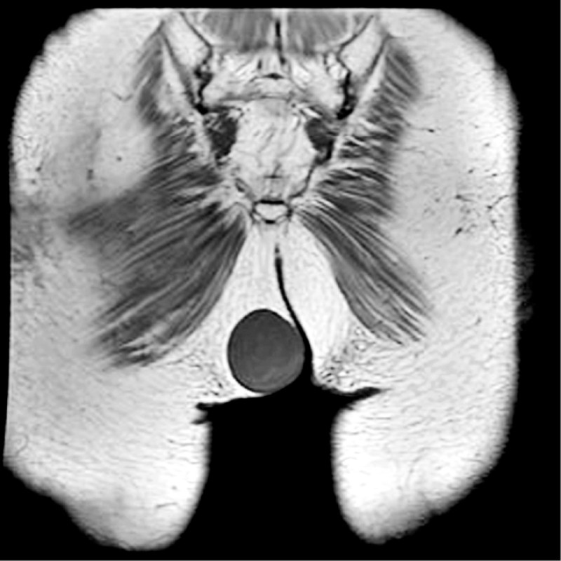 ▲患者經核磁共振檢查,臀部有一個如桃子般大的粉瘤。(照片提供/醫師鄭旭棠) ▲患者經核磁共振檢查,臀部有一個如桃子般大的粉瘤。(照片提供/醫師鄭旭棠)