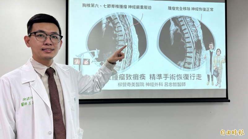 胸椎第7節有3公分大的腫瘤壓迫脊髓神經(左)、切除腫瘤後恢復神經暢通的術前術後對照。(記者楊金城攝) 胸椎第7節有3公分大的腫瘤壓迫脊髓神經(左)、切除腫瘤後恢復神經暢通的術前術後對照。(記者楊金城攝)