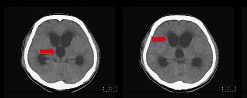 油漆工術前腦部斷層掃描，發現腦室脹大（紅色箭頭，黑色部份構造）。（民生醫院提供）