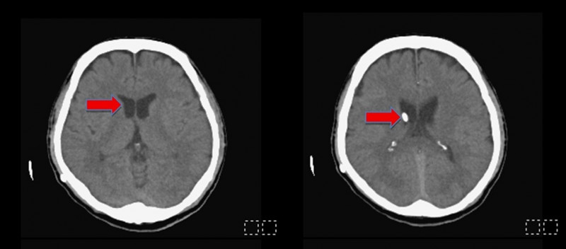 手術後半年，脹大的腦室皆已恢復正常大小，白點為放置右側腦室的導管。（民生醫院提供）