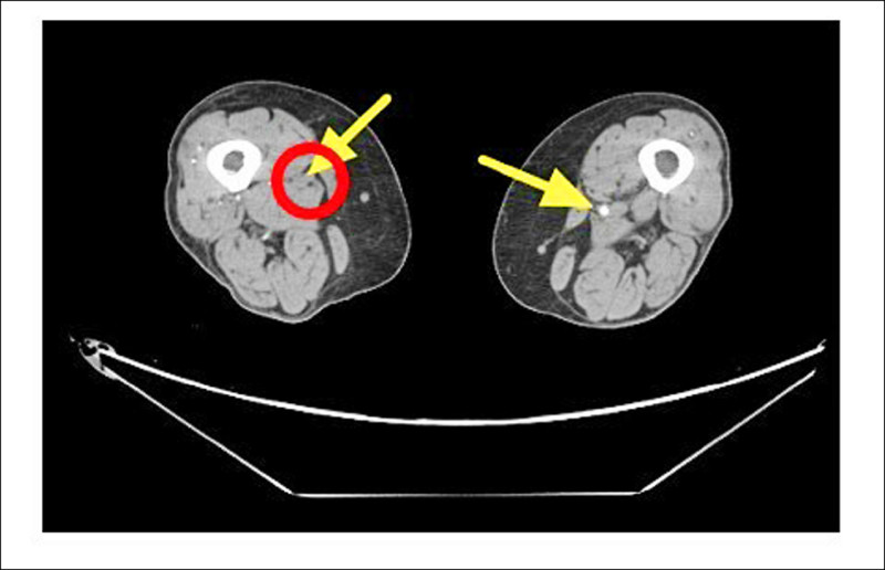 ▲血管攝影顯示,患者的右股動脈血管阻塞(紅圈處)。(聯新國際醫院提供) ▲血管攝影顯示,患者的右股動脈血管阻塞(紅圈處)。(聯新國際醫院提供)